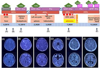 Anti-γ-aminobutyric acid-A receptor encephalitis with refractory seizures and cognitive impairment in a young woman: A case report